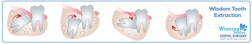 Wisdom Tooth Extraction removal